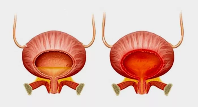 Bexiga normal (esquerda) e inflamação da bexiga com cistite (direita)